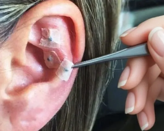 Auriculoterapia
